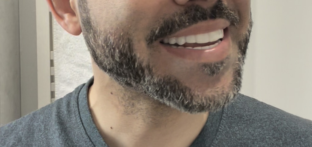 shiny smile pop in veneers