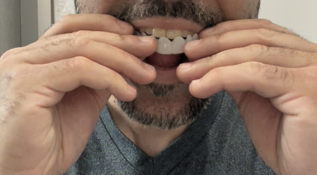 shiny smile veneers pop in veneers