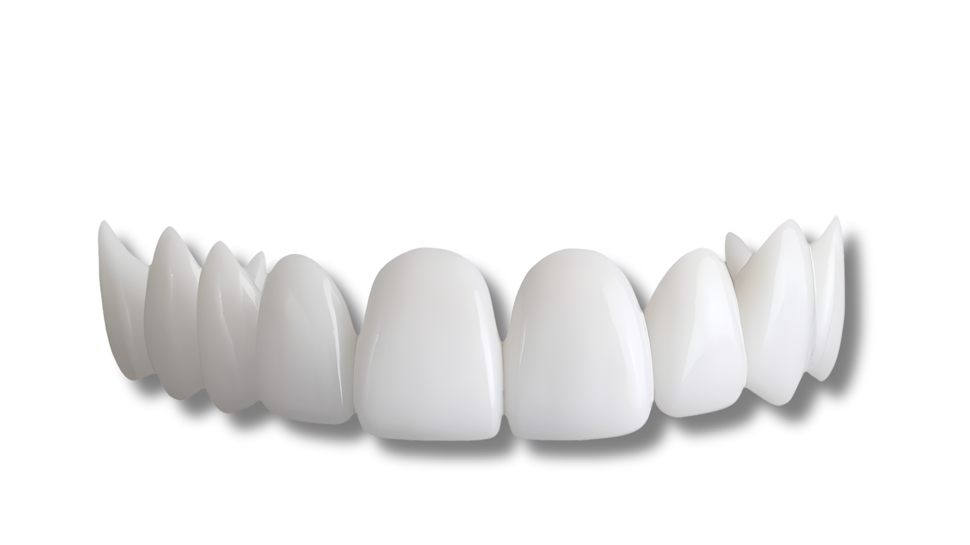 shiny smile veneers top