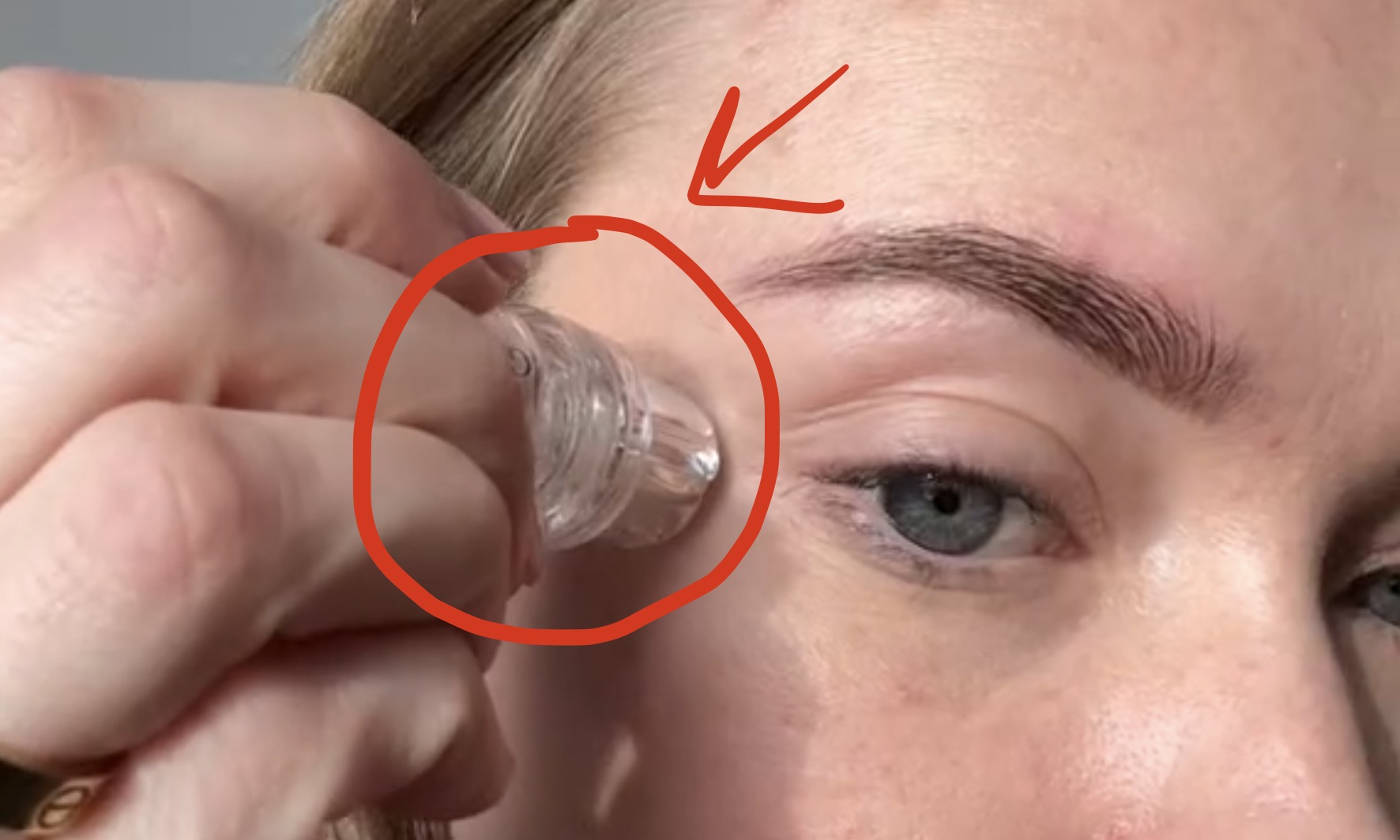 Glamory Microneedling